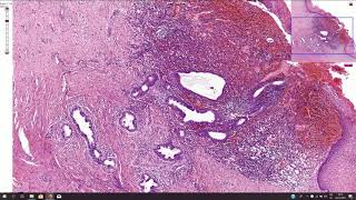 Endometriosis  Histopathology [upl. by Kecaj942]