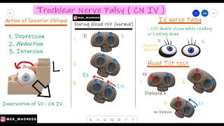 Trochlear Nerve Palsy  CN IV  Why Head Tilt   Action of Superior Oblique Med Madness [upl. by Desimone]