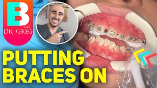 Getting Braces Put On and COLORS Vlog of Time Lapse [upl. by Alarise636]