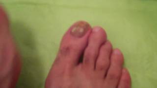 TOENAIL FUNGUS DOCUMENTARY DAY 1 [upl. by Kamillah743]