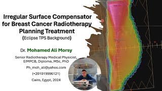 Irregular Surface Compensator Technique for Breast Cancer Radiotherapy Planning Treatment [upl. by Anitnatsnok]