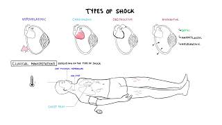 Approach to Shock  types hypovolemic cardiogenic distributive anaphylaxis pathology treatment [upl. by Reimer]