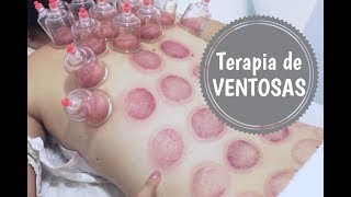 TERAPIA DE VENTOSAS  MINHA EXPERIÊNCIA [upl. by Creath]