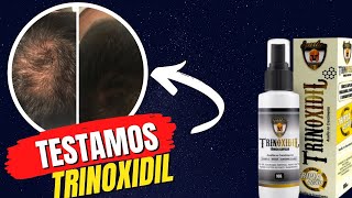 Testei O Trioxidil Funciona Mesmo Trioxidil ANTES E DEPOIS Trioxidil Resultados [upl. by Yeslek869]