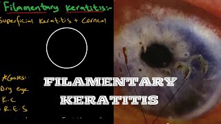 Filamentary Keratitis  Ophthalmology [upl. by Alius]