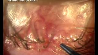 Demodex Blepharitis Is it for real [upl. by Divaj]