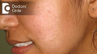 How does Laser work to remove sun tan amp age spots  Dr K Prem Anand [upl. by Anna-Maria]