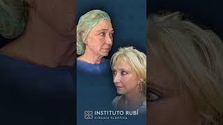 Rejuvenecimiento facial completo con lifting cervicofacial [upl. by Ranie414]