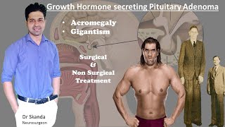 Pituitary Adenoma secreting Growth Hormone AcromegalyGigantism Treatment By Dr Skanda NSx [upl. by Benjamen]