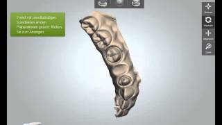 3shape Trios Intraoralscanner Workflow [upl. by Wash424]