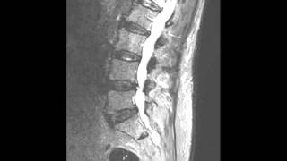 Lumbar Insufficiency Fracture [upl. by Xantha]