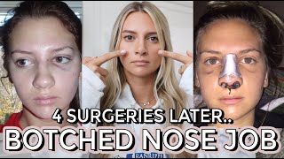 My Botched Nose Job  4 SURGERIES [upl. by Chambers103]