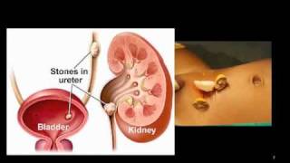 Bladder Stones [upl. by Aubigny]