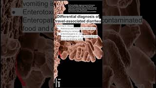 Differential diagnosis of travelassociated diarrhea [upl. by Mercier635]