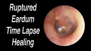 Ruptured Eardrum Healing Closed Time Lapse  A Hole in Eardrum Usually Heals Closed on Its Own [upl. by Bilak]