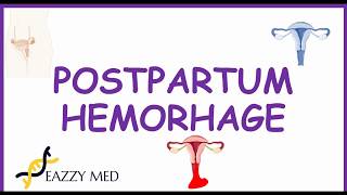 Postpartum Hemorrhage PPH causesrisk factorsprevention and treatment [upl. by Spenser]