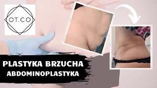 Płaski Brzuch czyli Abdominoplastyka na czym polega zabieg  OTCO Clinic [upl. by Dorweiler]