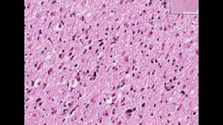 Histopathology BrainAstrocytoma [upl. by Abe]