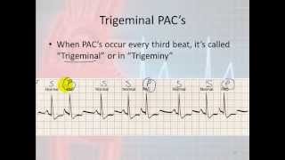 Basic Electrophysiology part 7  Atrial Rhythms part 1 Introduction and PACs [upl. by Yelik]