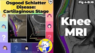 Fig 4B16 Osgood Schlatter Disease Cartilaginous Stage [upl. by Nsaj109]