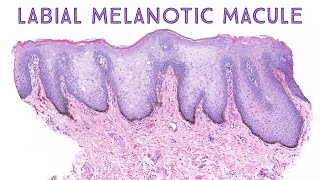 Labial melanotic macule brown spot on lip Stony Brook Case 1 dermatology dermatopathology [upl. by Uel1]