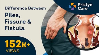 Difference Between Piles Fissure and Fistula  Call Now  9821388242 [upl. by Ayekin957]