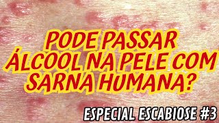 PODE PASSAR ÁLCOOL NA PELE COM SARNA HUMANA  ESPECIAL ESCABIOSE 3 [upl. by Miehar]