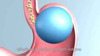 Endoscopic balloon insertion for weight reduction Step by step quotUNCUTquot By Dr Yerdel [upl. by Hadwin]