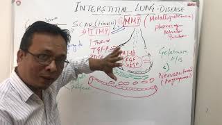 Interstitial lung diseasepathophysiology [upl. by Towne]