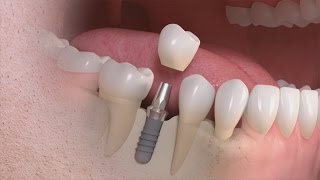 Straumann  Tratamento de um único dente com solução implantosuportada [upl. by Purpura]