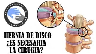 ¿Es necesaria la cirugia de hernia discal [upl. by Venus]