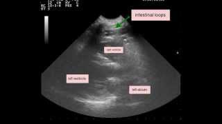 Peritoneopericardial Diaphragmatic Hernia PPDH [upl. by Ruffo]