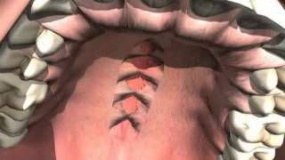 What is a Cleft Palate [upl. by Percival]