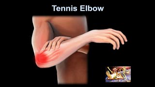 Tennis Elbow why it hurts Everything You Need To Know  Dr Nabil Ebraheim [upl. by Hum]