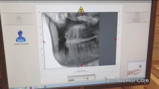 MyRay 3D CBCT scan [upl. by Dwain]