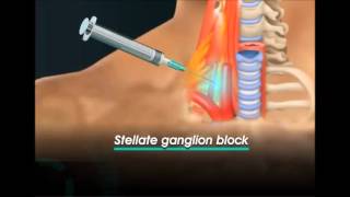 stellate ganglion block [upl. by Idyak]