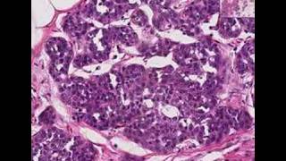 Histopathology Breast Lobular carcinoma in situ [upl. by Lessirg]