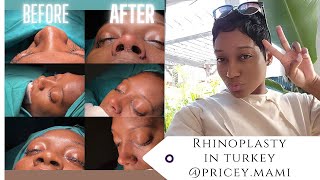 Turkey Vlog  Ethnic Rhinoplasty  PriceyMami [upl. by Nywloc650]