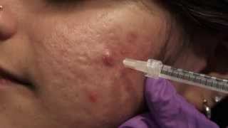 Watch amp Learn Intralesional injections [upl. by Eselahs]