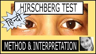 हिन्दी Hirschberg Test कैसे करें  Squint Examination [upl. by Htirehc192]