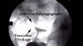 Selective Salpingography for blocked fallopian tubes [upl. by Huai490]