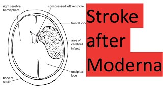 Stroke and death after Moderna [upl. by Newsom]