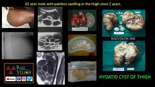 Hydatid cysts Imaging and complications [upl. by Yrroc]