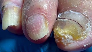 Onychomycosis infected the whole foot professional pedicure master【Pedicure Master Lin Jun】 [upl. by Lantz]