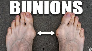 Bunions  Hallux Valgus Diagnosis Exercises Treatment [upl. by Ciccia]