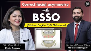 Correction of Misaligned Jaw amp Facial Asymmetry  Bilateral Sagittal Split Osteotomy BSSO Surgery [upl. by Gardiner]