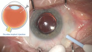 Ozurdex Implant Intravitreal Eye injection for Treatment of Retinal Oedema and Inflammation [upl. by Assetan525]