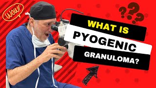 What is a Pyogenic Granuloma and How to Remove it [upl. by Phillipe]