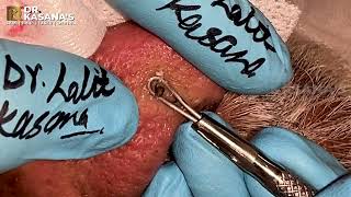 70 YEAR OLD NOSE BLACKHEADS REMOVAL AT DRKASANAS CLINIC [upl. by Lrad966]