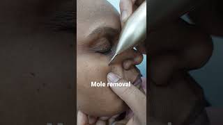 mole removal by cautery pen [upl. by Beacham]